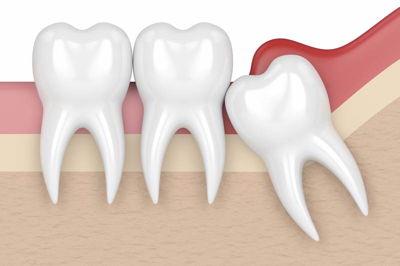 Wisdom Tooth Removal in Miami